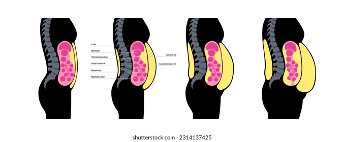 Visceral fat medical poster. Belly fat surrounds internal organs in abdominal cavity. Overweight disease concept. Losing weight, liposuction and diet. Obesity human silhouette flat vector illustration