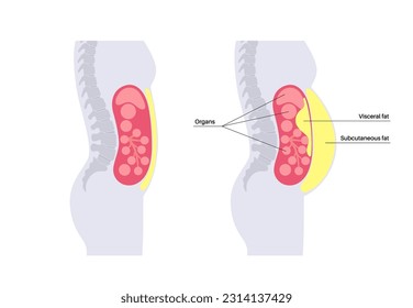 Afiche médico de grasa visceral. Las grasas del vientre rodean los órganos internos en la cavidad abdominal. Concepto de enfermedad por sobrepeso. Pérdida de peso, liposucción y dieta. Obesidad de la silueta humana ilustración vectorial plana