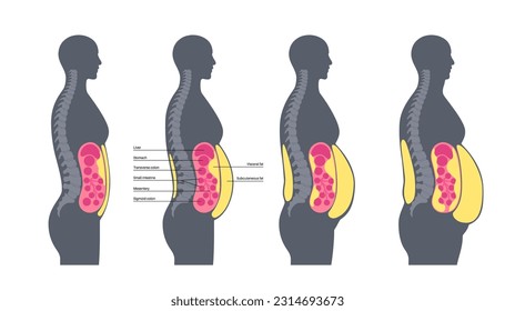 Afiche médico de grasa visceral. Las grasas del vientre rodean los órganos internos en la cavidad abdominal. Concepto de enfermedad por sobrepeso. Pérdida de peso, liposucción y dieta. Obesidad de la silueta humana ilustración vectorial plana