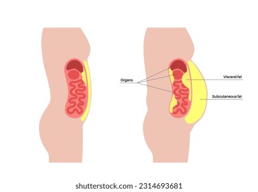 Visceral fat medical poster. Belly fat surrounds internal organs in abdominal cavity. Overweight disease concept. Losing weight, liposuction and diet. Obesity human silhouette flat vector illustration