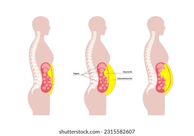 Visceral fat medical poster. Belly fat surrounds internal organs in abdominal cavity. Overweight disease concept. Losing weight, liposuction and diet. Obesity human silhouette flat vector illustration