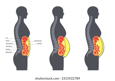 Afiche médico de grasa visceral. Las grasas del vientre rodean los órganos internos en la cavidad abdominal. Concepto de enfermedad por sobrepeso. Pérdida de peso, liposucción y dieta. Obesidad de la silueta humana ilustración vectorial plana