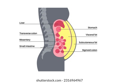 Visceral fat medical poster. Belly fat surrounds internal organs in abdominal cavity. Overweight disease concept. Losing weight, liposuction and diet. Obesity human silhouette flat vector illustration