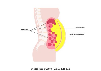 Visceral fat medical poster. Belly fat surrounds internal organs in abdominal cavity. Overweight disease concept. Losing weight, liposuction and diet. Obesity human silhouette flat vector illustration