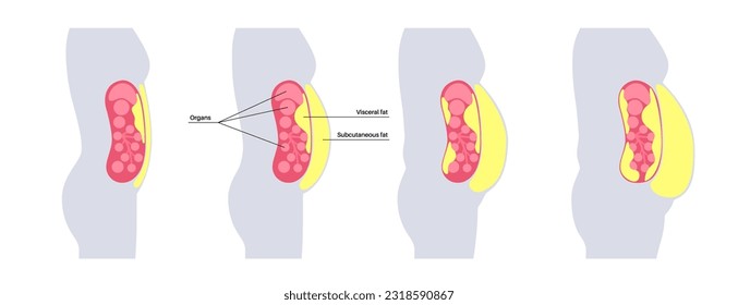 Afiche médico de grasa visceral. Las grasas del vientre rodean los órganos internos en la cavidad abdominal. Concepto de enfermedad por sobrepeso. Pérdida de peso, liposucción y dieta. Obesidad de la silueta humana ilustración vectorial plana