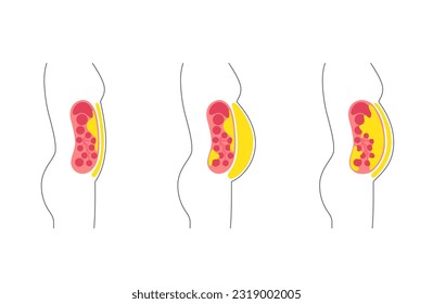 Afiche médico de grasa visceral. Las grasas del vientre rodean los órganos internos en la cavidad abdominal. Concepto de enfermedad por sobrepeso. Pérdida de peso, liposucción y dieta. Obesidad de la silueta humana ilustración vectorial plana