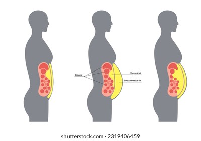 Afiche médico de grasa visceral. Las grasas del vientre rodean los órganos internos en la cavidad abdominal. Concepto de enfermedad por sobrepeso. Pérdida de peso, liposucción y dieta. Obesidad de la silueta humana ilustración vectorial plana