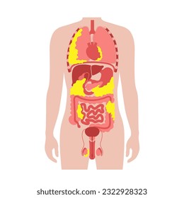 Visceral fat medical poster. Belly fat surrounds internal organs in abdominal cavity. Overweight disease concept. Losing weight, liposuction and diet. Obesity human silhouette flat vector illustration