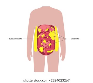 Visceral fat medical poster. Belly fat surrounds internal organs in abdominal cavity. Overweight disease concept. Losing weight, liposuction and diet. Obesity human silhouette flat vector illustration