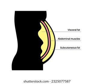 Visceral fat medical poster. Belly fat surrounds internal organs in abdominal cavity. Overweight disease concept. Losing weight, liposuction and diet. Obesity human silhouette flat vector illustration