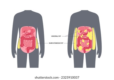 Visceral fat medical poster. Belly fat surrounds internal organs in abdominal cavity. Overweight disease concept. Losing weight, liposuction and diet. Obesity human silhouette flat vector illustration