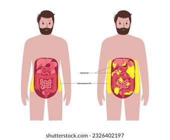 Visceral fat medical poster. Belly fat surrounds internal organs in abdominal cavity. Overweight disease concept. Losing weight, liposuction and diet. Obesity human silhouette flat vector illustration