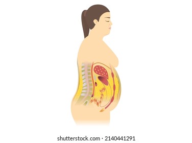 Visceral fat and subcutaneous fat accumulate around a woman's waistline. Medical and health diagram about belly fat.