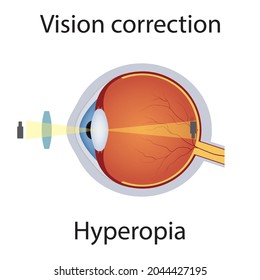 Korrektur des Sehvermögens der Hyperopia-Illustration. Sehstörungen. Sehfehler korrigiert durch das Convex Lens Konzept. Detaillierte Anatomie Eyeball mit Hyperopia Defect. Einziger Vektorgrafik.