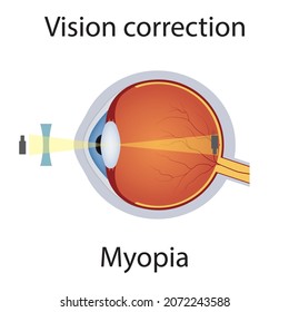 Corrección de visión de la ilustración de Myopia. Trastornos De La Visión. Defecto ocular corregido por el concepto de lente cóncavo. Anatomía Detallada de Oleosis con Miopía Defecto. Vector aislado.