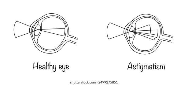 A vision defect characterized by uneven curvature of the hemisphere of the cornea and the absence of a single focal point. Healthy eye and eye with astigmatism. Vector medical illustration.