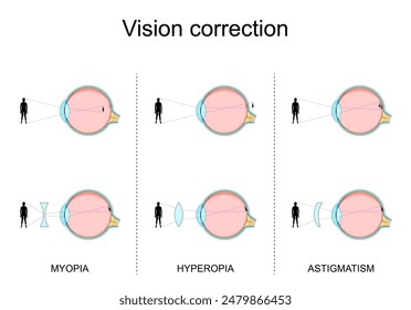 Defectos de visión. Miopía, Hipermetropía, Astigmatismo. Corrección de la visión por gafas. Errores de refracción. Sección transversal del ojo humano. Primer plano de una mácula, retina, esclerótica y fóvea. 