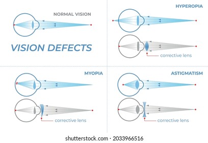 Sehstörungen und deren Korrektur mit intraokulären Linsen. Sehstörungen mit Hyperopie, Myopie und Astigmatismus. Abschnitt eines Auges für die Infografik des Augenarzt