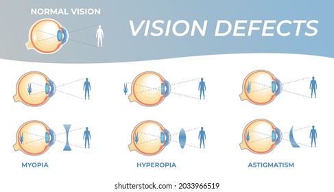 Sehstörungen und deren Korrektur mit intraokulären Linsen. Sehstörungen mit Hyperopie, Myopie und Astigmatismus. Abschnitt eines Auges für die Infografik des Augenarzt