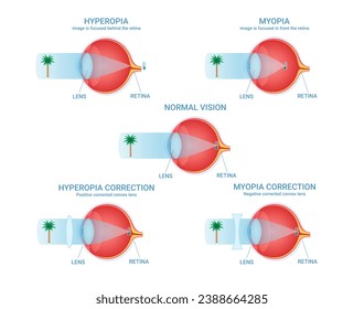 Vision defects visual impairment normal myopia and hyperopia correction infographic scheme vector flat illustration. Optical anatomy diagram eye medical structure with lens and retina ophthalmology