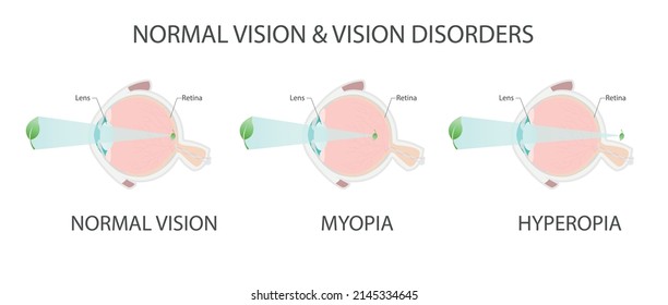 Vision disorders. Anatomy of the eyeball. Normal vision, myopia, hyperopia. Projection of the image in the eye. Vector graphic illustration.