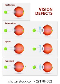 mi a myopia hyperopia asztigmatizmus