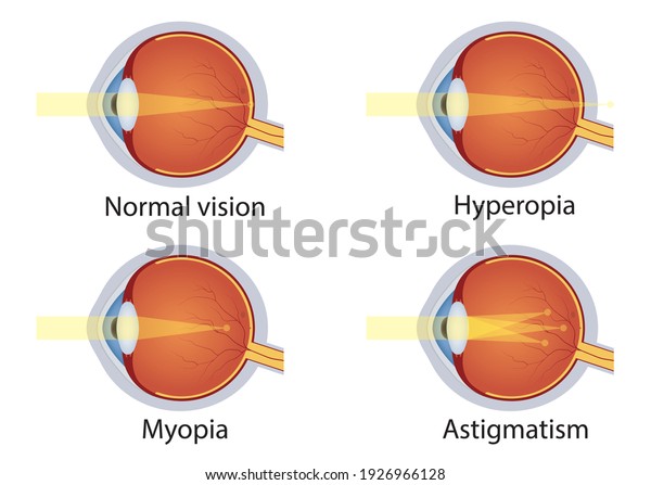 Vision Disorders Concept Eyes Defect Normal Stock Vector (Royalty Free ...