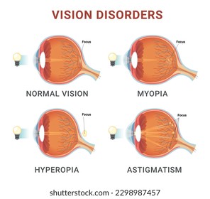 Vision disorders medical education scheme with names and eyeball structure vector illustration. Human anatomical eye optical illness diagnosis poster normal myopia hyperopia astigmatism sight problem