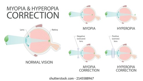 Vision disorders. Normal vision, myopia, hyperopia. Myopia and hyperopia correction. Projection of the image in the eye. Vector graphic illustration.