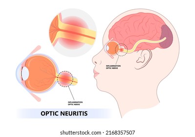 inflamación de la anatomía del nervio ocular óptica en