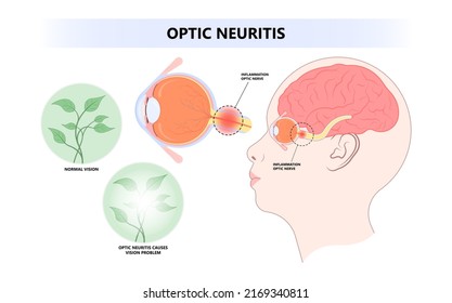 Vision loss and visual field eye disc swollen pain retina Demyelination viral Tumor cancer blind with lupus blurring spot light infectious antibody