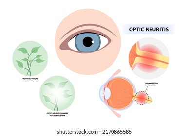 Vision loss and visual field eye disc swollen pain retina Demyelination viral Tumor cancer blind with lupus blurring spot light infectious antibody