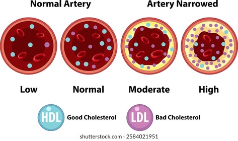 Visual comparison of cholesterol impact on arteries