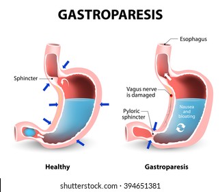 Visual comparison of healthy gastric and stomach with Gastroparesis.