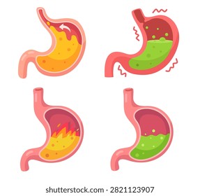 Visual guide to common stomach ailments acid reflux, heartburn, and upset stomach