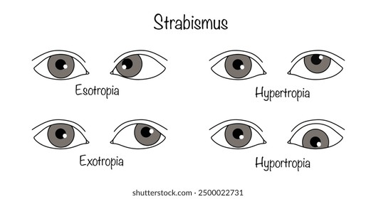 A visual impairment in which one or both eyes deviate from the visual axis towards the object being viewed. Types of strabismus. Vector illustration.