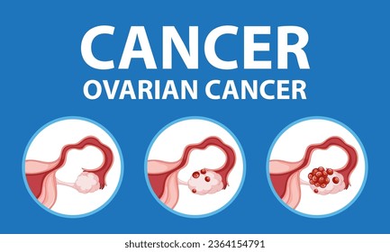 Visual representation of different stages of ovarian cancer in women