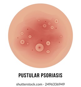 Una representación visual que muestra las características de la psoriasis pustular en la piel, destacando el enrojecimiento y las pústulas en un contexto clínico.