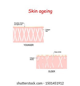 Visual representation of skin changes over a lifetime. in Young skin Collagen and elastin form the structure of the dermis making it tigh. In aging skin atrophy of collagen fibers formed wrinkles