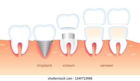 Visualization of Different Ways Orthodontic Restoration. Implant, Crown, Dental Veneer Isolated on White Background. Set of Teeth Problem. Diseased Tooth. Stomatology Aid Flat Vector Illustration.