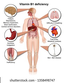 Vitamin B1 deficiency 3d medical vector illustration infographic on white background thiamine