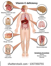 Vitamin C deficiency 3d medical vector illustration on white background