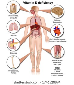 Vitamin D deficiency, 3d medical vector illustration isolated on white background