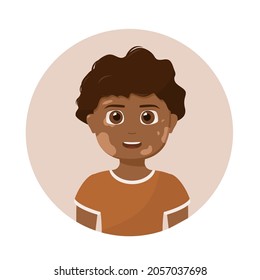 Vitiligo day. Little boy with vitiligo. Skin disease. Body care. Pigment problem. Happy children. Vector illustration