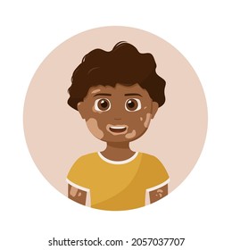 Vitiligo day. Little boy with vitiligo. Skin disease.Body care. Pigment problem. Happy children. Vector illustration