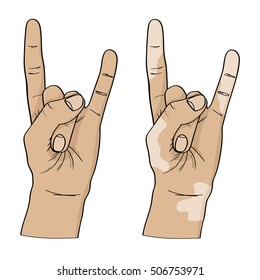 Vitiligo disease. Vector woman's hands isolated on white background.