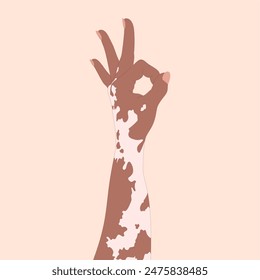 Vitiligo hand with OK sign. Vector illustration of a human hand with ok hand sign.