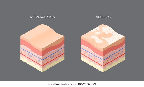 vitiligo and normal skin cross-section of human skin layers structure skincare medical concept flat horizontal