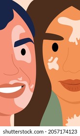 Vitiligo on the face of girls. Flat vector illustration. Postcard, poster, World Vitiligo Day