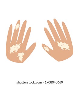 Vitiligo on the hands. White spots on the skin of the hands. Infographics vector illustration.